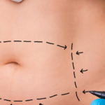 Os Benefícios da Lipoaspiração: Tudo o que Você Precisa Saber