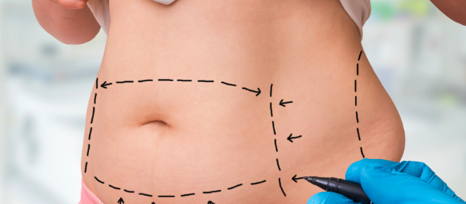 Os Benefícios da Lipoaspiração: Tudo o que Você Precisa Saber