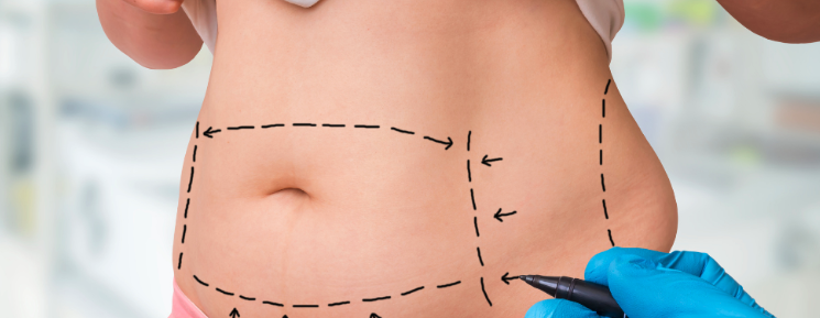 Os Benefícios da Lipoaspiração: Tudo o que Você Precisa Saber